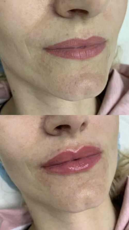 УВЕЛИЧЕНИЕ ГУБ ГИАЛУРОНОВОЙ КИСЛОТОЙ в Киеве от клиники Platinum Laser УВЕЛИЧЕНИЕ ГУБ ГИАЛУРОНОВОЙ КИСЛОТОЙ до и после фото 10
