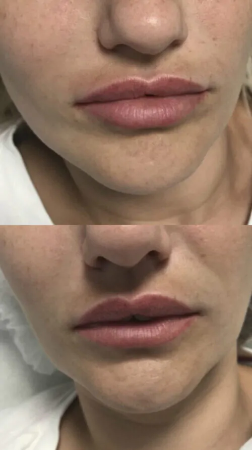 УВЕЛИЧЕНИЕ ГУБ ГИАЛУРОНОВОЙ КИСЛОТОЙ в Киеве от клиники Platinum Laser УВЕЛИЧЕНИЕ ГУБ ГИАЛУРОНОВОЙ КИСЛОТОЙ до и после фото 11