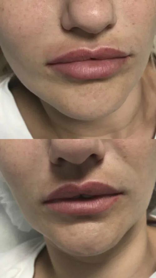 УВЕЛИЧЕНИЕ ГУБ ГИАЛУРОНОВОЙ КИСЛОТОЙ в Киеве от клиники Platinum Laser УВЕЛИЧЕНИЕ ГУБ ГИАЛУРОНОВОЙ КИСЛОТОЙ до и после фото 12