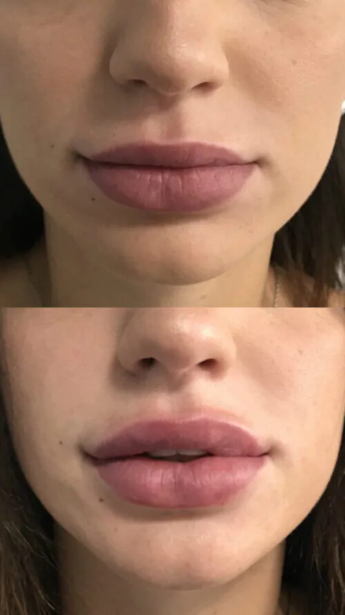 УВЕЛИЧЕНИЕ ГУБ ГИАЛУРОНОВОЙ КИСЛОТОЙ в Киеве от клиники Platinum Laser УВЕЛИЧЕНИЕ ГУБ ГИАЛУРОНОВОЙ КИСЛОТОЙ до и после фото 13