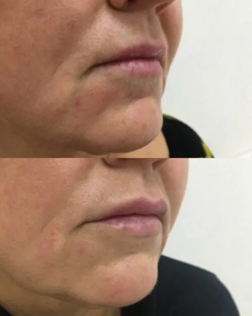 УВЕЛИЧЕНИЕ ГУБ ГИАЛУРОНОВОЙ КИСЛОТОЙ в Киеве от клиники Platinum Laser УВЕЛИЧЕНИЕ ГУБ ГИАЛУРОНОВОЙ КИСЛОТОЙ до и после фото 15