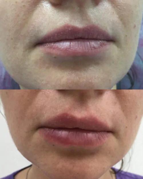УВЕЛИЧЕНИЕ ГУБ ГИАЛУРОНОВОЙ КИСЛОТОЙ в Киеве от клиники Platinum Laser УВЕЛИЧЕНИЕ ГУБ ГИАЛУРОНОВОЙ КИСЛОТОЙ до и после фото 16