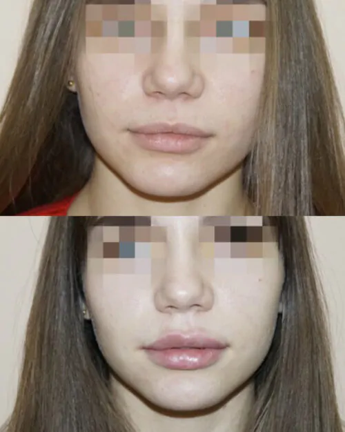 УВЕЛИЧЕНИЕ ГУБ ГИАЛУРОНОВОЙ КИСЛОТОЙ в Киеве от клиники Platinum Laser УВЕЛИЧЕНИЕ ГУБ ГИАЛУРОНОВОЙ КИСЛОТОЙ до и после фото 17