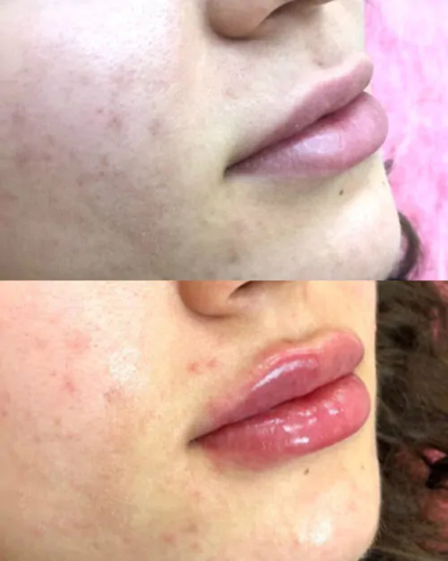 УВЕЛИЧЕНИЕ ГУБ ГИАЛУРОНОВОЙ КИСЛОТОЙ в Киеве от клиники Platinum Laser УВЕЛИЧЕНИЕ ГУБ ГИАЛУРОНОВОЙ КИСЛОТОЙ до и после фото 18