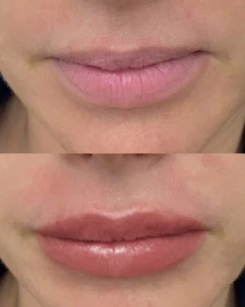 УВЕЛИЧЕНИЕ ГУБ ГИАЛУРОНОВОЙ КИСЛОТОЙ в Киеве от клиники Platinum Laser УВЕЛИЧЕНИЕ ГУБ ГИАЛУРОНОВОЙ КИСЛОТОЙ до и после фото 19