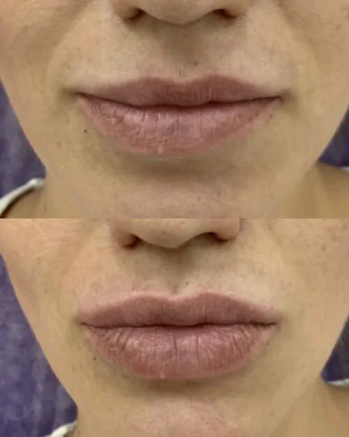 УВЕЛИЧЕНИЕ ГУБ ГИАЛУРОНОВОЙ КИСЛОТОЙ в Киеве от клиники Platinum Laser УВЕЛИЧЕНИЕ ГУБ ГИАЛУРОНОВОЙ КИСЛОТОЙ до и после фото 21