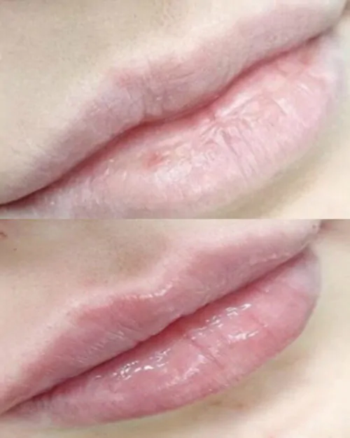 УВЕЛИЧЕНИЕ ГУБ ГИАЛУРОНОВОЙ КИСЛОТОЙ в Киеве от клиники Platinum Laser УВЕЛИЧЕНИЕ ГУБ ГИАЛУРОНОВОЙ КИСЛОТОЙ до и после фото 22