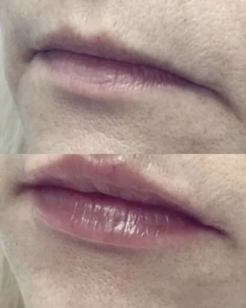 УВЕЛИЧЕНИЕ ГУБ ГИАЛУРОНОВОЙ КИСЛОТОЙ в Киеве от клиники Platinum Laser УВЕЛИЧЕНИЕ ГУБ ГИАЛУРОНОВОЙ КИСЛОТОЙ до и после фото 23