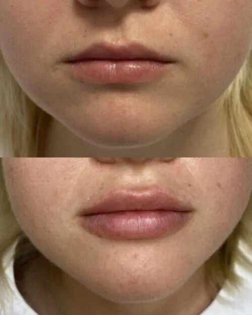 УВЕЛИЧЕНИЕ ГУБ ГИАЛУРОНОВОЙ КИСЛОТОЙ в Киеве от клиники Platinum Laser УВЕЛИЧЕНИЕ ГУБ ГИАЛУРОНОВОЙ КИСЛОТОЙ до и после фото 24
