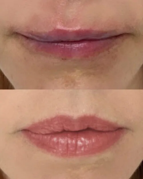 УВЕЛИЧЕНИЕ ГУБ ГИАЛУРОНОВОЙ КИСЛОТОЙ в Киеве от клиники Platinum Laser УВЕЛИЧЕНИЕ ГУБ ГИАЛУРОНОВОЙ КИСЛОТОЙ до и после фото 25