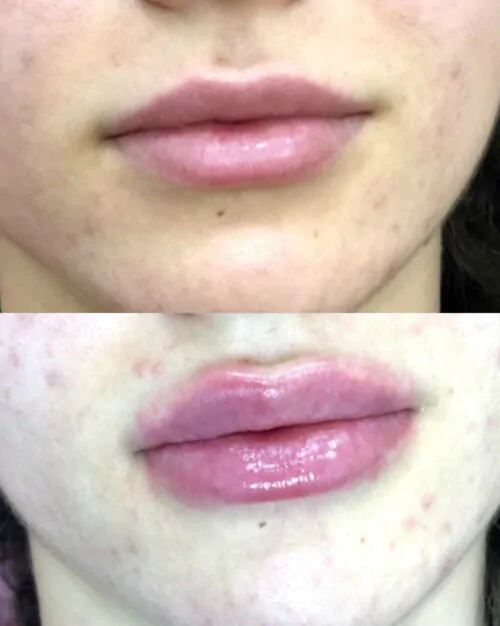 УВЕЛИЧЕНИЕ ГУБ ГИАЛУРОНОВОЙ КИСЛОТОЙ в Киеве от клиники Platinum Laser УВЕЛИЧЕНИЕ ГУБ ГИАЛУРОНОВОЙ КИСЛОТОЙ до и после фото 26