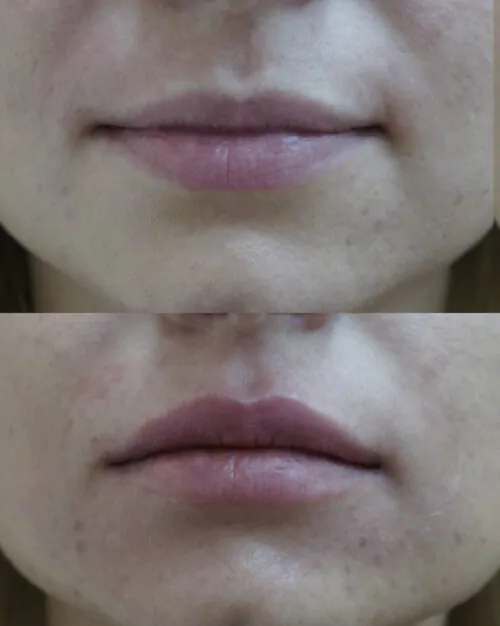 УВЕЛИЧЕНИЕ ГУБ ГИАЛУРОНОВОЙ КИСЛОТОЙ в Киеве от клиники Platinum Laser УВЕЛИЧЕНИЕ ГУБ ГИАЛУРОНОВОЙ КИСЛОТОЙ до и после фото 27