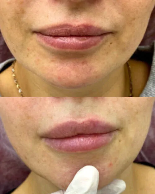 УВЕЛИЧЕНИЕ ГУБ ГИАЛУРОНОВОЙ КИСЛОТОЙ в Киеве от клиники Platinum Laser УВЕЛИЧЕНИЕ ГУБ ГИАЛУРОНОВОЙ КИСЛОТОЙ до и после фото 29