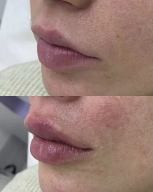 УВЕЛИЧЕНИЕ ГУБ ГИАЛУРОНОВОЙ КИСЛОТОЙ в Киеве от клиники Platinum Laser УВЕЛИЧЕНИЕ ГУБ ГИАЛУРОНОВОЙ КИСЛОТОЙ до и после фото 30