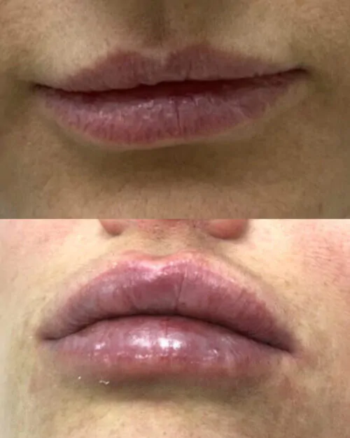 УВЕЛИЧЕНИЕ ГУБ ГИАЛУРОНОВОЙ КИСЛОТОЙ в Киеве от клиники Platinum Laser УВЕЛИЧЕНИЕ ГУБ ГИАЛУРОНОВОЙ КИСЛОТОЙ до и после фото 31