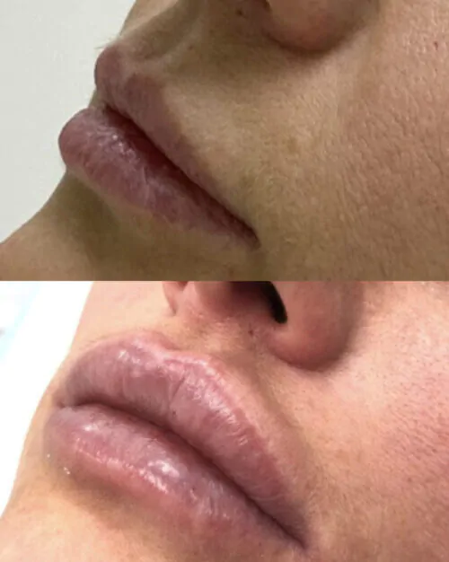 УВЕЛИЧЕНИЕ ГУБ ГИАЛУРОНОВОЙ КИСЛОТОЙ в Киеве от клиники Platinum Laser УВЕЛИЧЕНИЕ ГУБ ГИАЛУРОНОВОЙ КИСЛОТОЙ до и после фото 32