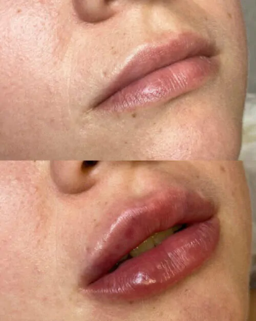 УВЕЛИЧЕНИЕ ГУБ ГИАЛУРОНОВОЙ КИСЛОТОЙ в Киеве от клиники Platinum Laser УВЕЛИЧЕНИЕ ГУБ ГИАЛУРОНОВОЙ КИСЛОТОЙ до и после фото 33