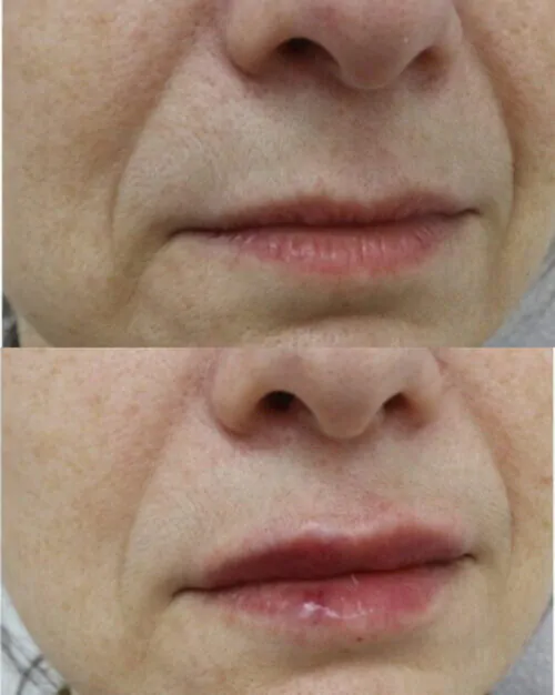 УВЕЛИЧЕНИЕ ГУБ ГИАЛУРОНОВОЙ КИСЛОТОЙ в Киеве от клиники Platinum Laser УВЕЛИЧЕНИЕ ГУБ ГИАЛУРОНОВОЙ КИСЛОТОЙ до и после фото 34