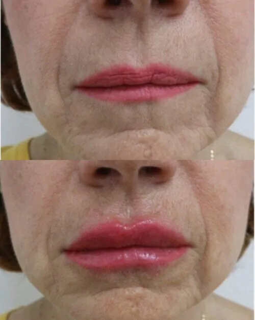 УВЕЛИЧЕНИЕ ГУБ ГИАЛУРОНОВОЙ КИСЛОТОЙ в Киеве от клиники Platinum Laser УВЕЛИЧЕНИЕ ГУБ ГИАЛУРОНОВОЙ КИСЛОТОЙ до и после фото 35