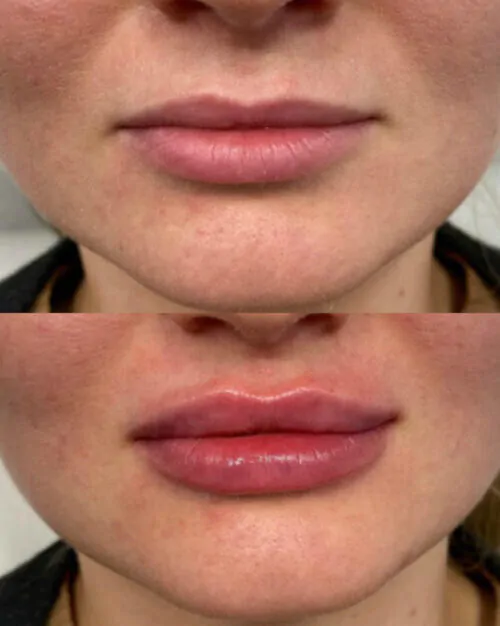 УВЕЛИЧЕНИЕ ГУБ ГИАЛУРОНОВОЙ КИСЛОТОЙ в Киеве от клиники Platinum Laser УВЕЛИЧЕНИЕ ГУБ ГИАЛУРОНОВОЙ КИСЛОТОЙ до и после фото 36