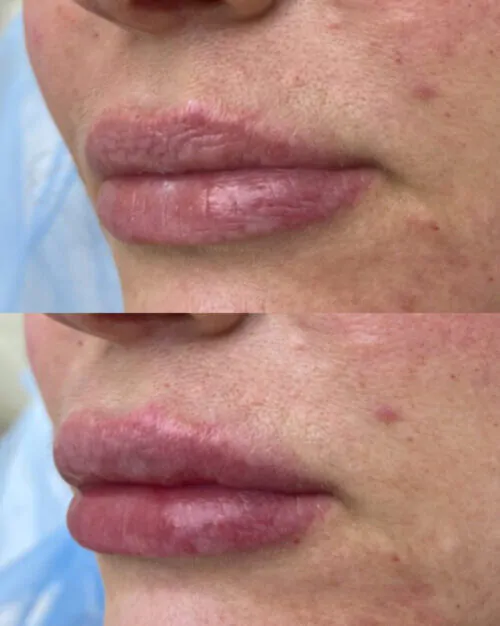 УВЕЛИЧЕНИЕ ГУБ ГИАЛУРОНОВОЙ КИСЛОТОЙ в Киеве от клиники Platinum Laser УВЕЛИЧЕНИЕ ГУБ ГИАЛУРОНОВОЙ КИСЛОТОЙ до и после фото 37
