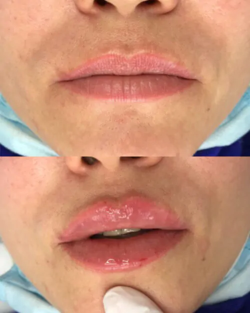 УВЕЛИЧЕНИЕ ГУБ ГИАЛУРОНОВОЙ КИСЛОТОЙ в Киеве от клиники Platinum Laser УВЕЛИЧЕНИЕ ГУБ ГИАЛУРОНОВОЙ КИСЛОТОЙ до и после фото 38