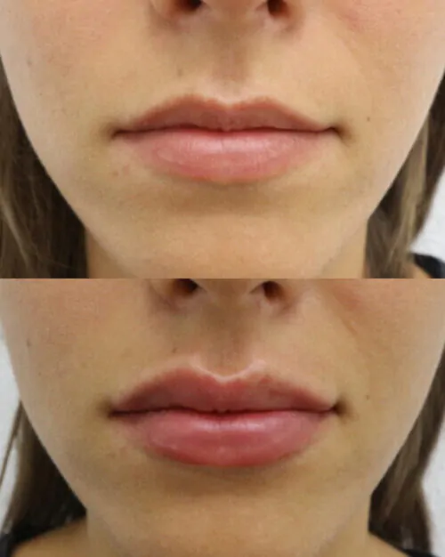 УВЕЛИЧЕНИЕ ГУБ ГИАЛУРОНОВОЙ КИСЛОТОЙ в Киеве от клиники Platinum Laser УВЕЛИЧЕНИЕ ГУБ ГИАЛУРОНОВОЙ КИСЛОТОЙ до и после фото 39