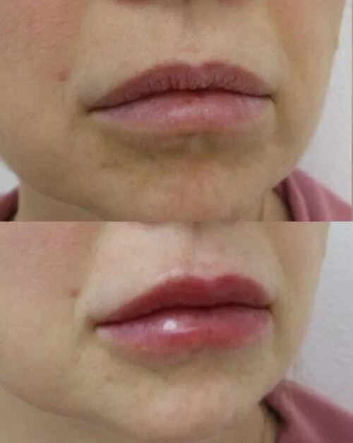 УВЕЛИЧЕНИЕ ГУБ ГИАЛУРОНОВОЙ КИСЛОТОЙ в Киеве от клиники Platinum Laser УВЕЛИЧЕНИЕ ГУБ ГИАЛУРОНОВОЙ КИСЛОТОЙ до и после фото 41