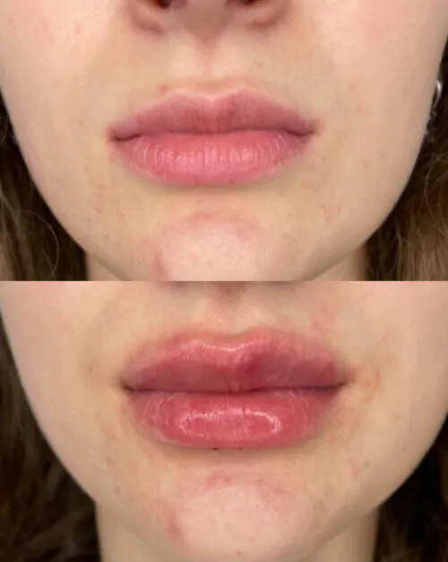 УВЕЛИЧЕНИЕ ГУБ ГИАЛУРОНОВОЙ КИСЛОТОЙ в Киеве от клиники Platinum Laser УВЕЛИЧЕНИЕ ГУБ ГИАЛУРОНОВОЙ КИСЛОТОЙ до и после фото 42