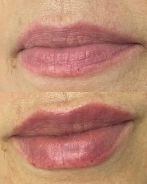 УВЕЛИЧЕНИЕ ГУБ ГИАЛУРОНОВОЙ КИСЛОТОЙ в Киеве от клиники Platinum Laser УВЕЛИЧЕНИЕ ГУБ ГИАЛУРОНОВОЙ КИСЛОТОЙ до и после фото 43