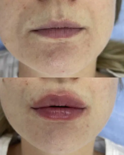 УВЕЛИЧЕНИЕ ГУБ ГИАЛУРОНОВОЙ КИСЛОТОЙ в Киеве от клиники Platinum Laser УВЕЛИЧЕНИЕ ГУБ ГИАЛУРОНОВОЙ КИСЛОТОЙ до и после фото 44