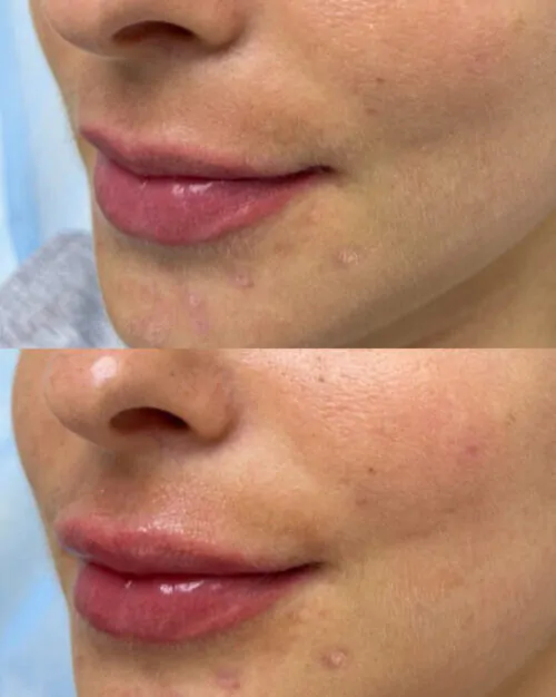 УВЕЛИЧЕНИЕ ГУБ ГИАЛУРОНОВОЙ КИСЛОТОЙ в Киеве от клиники Platinum Laser УВЕЛИЧЕНИЕ ГУБ ГИАЛУРОНОВОЙ КИСЛОТОЙ до и после фото 45