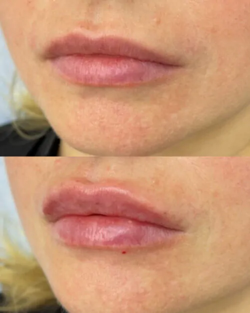 УВЕЛИЧЕНИЕ ГУБ ГИАЛУРОНОВОЙ КИСЛОТОЙ в Киеве от клиники Platinum Laser УВЕЛИЧЕНИЕ ГУБ ГИАЛУРОНОВОЙ КИСЛОТОЙ до и после фото 46
