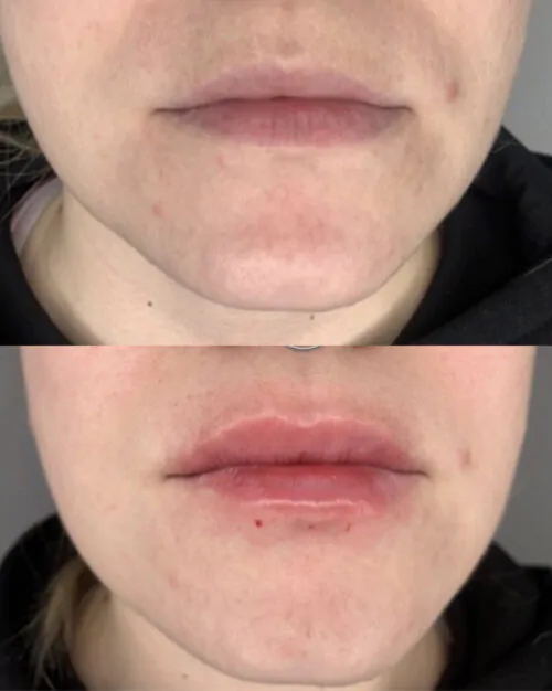 УВЕЛИЧЕНИЕ ГУБ ГИАЛУРОНОВОЙ КИСЛОТОЙ в Киеве от клиники Platinum Laser УВЕЛИЧЕНИЕ ГУБ ГИАЛУРОНОВОЙ КИСЛОТОЙ до и после фото 47