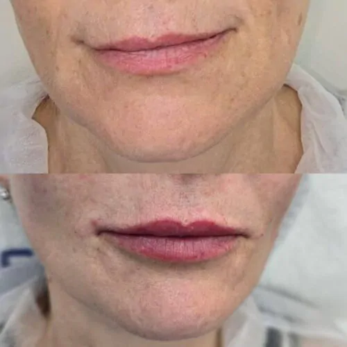 УВЕЛИЧЕНИЕ ГУБ ГИАЛУРОНОВОЙ КИСЛОТОЙ в Киеве от клиники Platinum Laser УВЕЛИЧЕНИЕ ГУБ ГИАЛУРОНОВОЙ КИСЛОТОЙ до и после фото 65