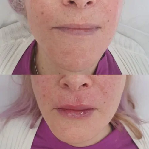 УВЕЛИЧЕНИЕ ГУБ ГИАЛУРОНОВОЙ КИСЛОТОЙ в Киеве от клиники Platinum Laser УВЕЛИЧЕНИЕ ГУБ ГИАЛУРОНОВОЙ КИСЛОТОЙ до и после фото 64