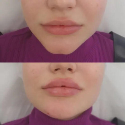 УВЕЛИЧЕНИЕ ГУБ ГИАЛУРОНОВОЙ КИСЛОТОЙ в Киеве от клиники Platinum Laser УВЕЛИЧЕНИЕ ГУБ ГИАЛУРОНОВОЙ КИСЛОТОЙ до и после фото 63