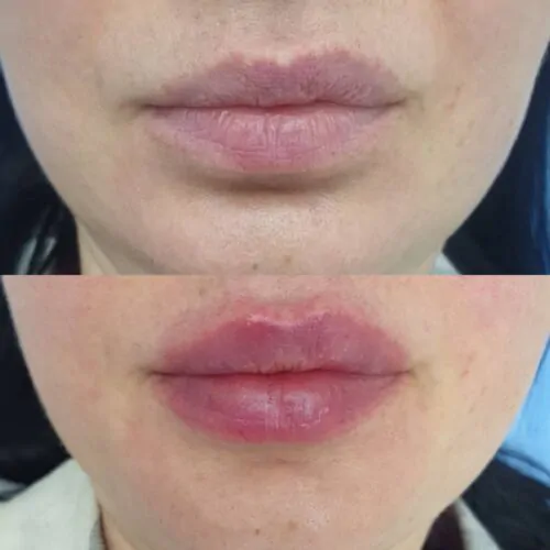 УВЕЛИЧЕНИЕ ГУБ ГИАЛУРОНОВОЙ КИСЛОТОЙ в Киеве от клиники Platinum Laser УВЕЛИЧЕНИЕ ГУБ ГИАЛУРОНОВОЙ КИСЛОТОЙ до и после фото 62