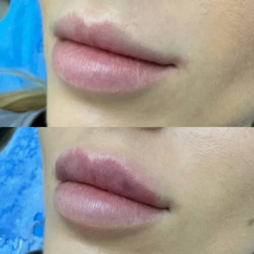 УВЕЛИЧЕНИЕ ГУБ ГИАЛУРОНОВОЙ КИСЛОТОЙ в Киеве от клиники Platinum Laser УВЕЛИЧЕНИЕ ГУБ ГИАЛУРОНОВОЙ КИСЛОТОЙ до и после фото 61