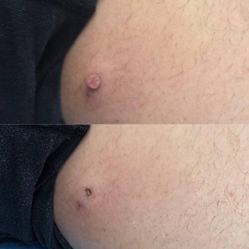 Лазерное удаление новообразований в Киеве от клиники Platinum Laser Лазерное удаление новообразований до и после фото 37
