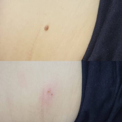 Лазерное удаление новообразований в Киеве от клиники Platinum Laser Лазерное удаление новообразований до и после фото 38