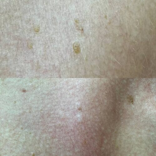 Лазерное удаление новообразований в Киеве от клиники Platinum Laser Лазерное удаление новообразований до и после фото 39