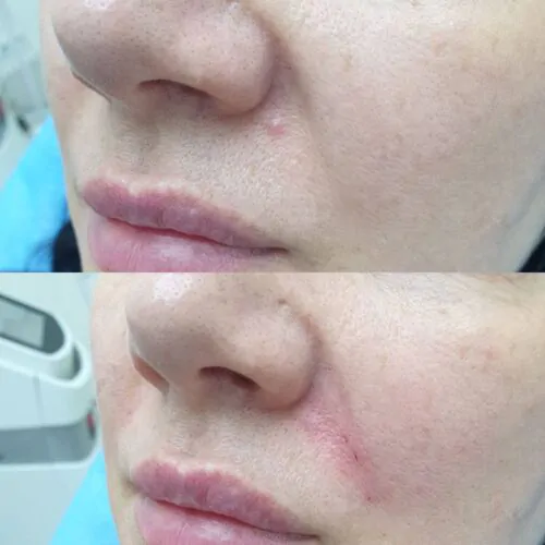 Контурная пластика лица до и после фото 19