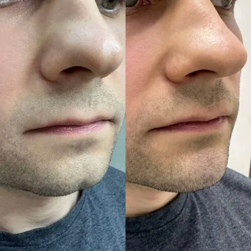 Контурная пластика лица до и после фото 20