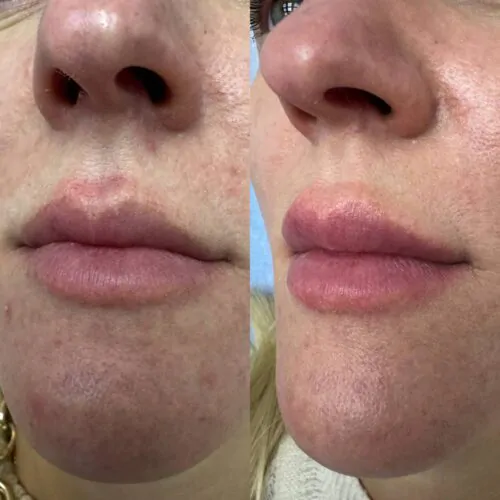 УВЕЛИЧЕНИЕ ГУБ ГИАЛУРОНОВОЙ КИСЛОТОЙ в Киеве от клиники Platinum Laser УВЕЛИЧЕНИЕ ГУБ ГИАЛУРОНОВОЙ КИСЛОТОЙ до и после фото 70