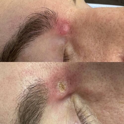 Лазерное удаление новообразований в Киеве от клиники Platinum Laser Лазерное удаление новообразований до и после фото 56