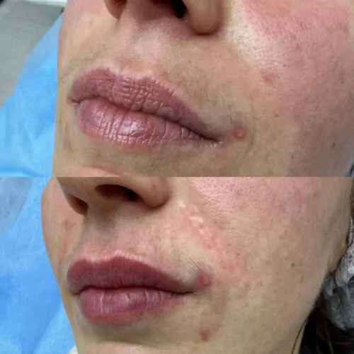 Контурная пластика лица до и после фото 23