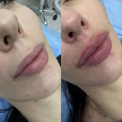 УВЕЛИЧЕНИЕ ГУБ ГИАЛУРОНОВОЙ КИСЛОТОЙ в Киеве от клиники Platinum Laser УВЕЛИЧЕНИЕ ГУБ ГИАЛУРОНОВОЙ КИСЛОТОЙ до и после фото 69