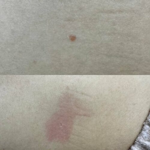Лазерное удаление новообразований в Киеве от клиники Platinum Laser Лазерное удаление новообразований до и после фото 54