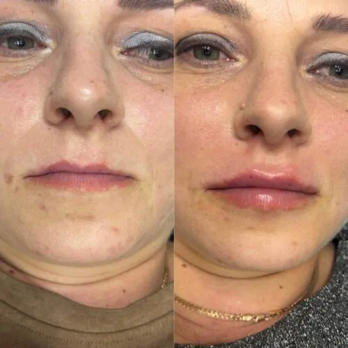 УВЕЛИЧЕНИЕ ГУБ ГИАЛУРОНОВОЙ КИСЛОТОЙ в Киеве от клиники Platinum Laser УВЕЛИЧЕНИЕ ГУБ ГИАЛУРОНОВОЙ КИСЛОТОЙ до и после фото 68